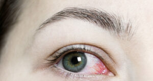 Urgent Eye Care: Protocols for Handling Common Eye Emergencies