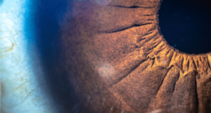 A New Target in the Fight Against Wet AMD