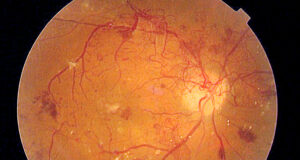 Socioeconomic Disadvantage and Race Compound Lapses in Diabetic Retinopathy Care