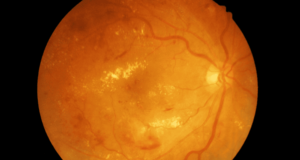 Managing Diabetic Eye Disease: Strategy and Patient Education medical photo of retina with diabetic retinopathy