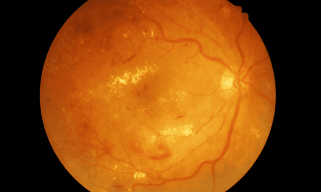 medical photo of retina with diabetic retinopathy